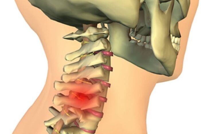 Nackenschmerzen durch Arthrose